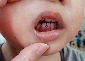 歯をぶつけた 出血して歯がぐらついたときの対応と経過 ナース みかん のブログ