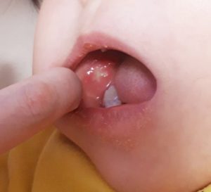 幼児のひどい口内炎写真